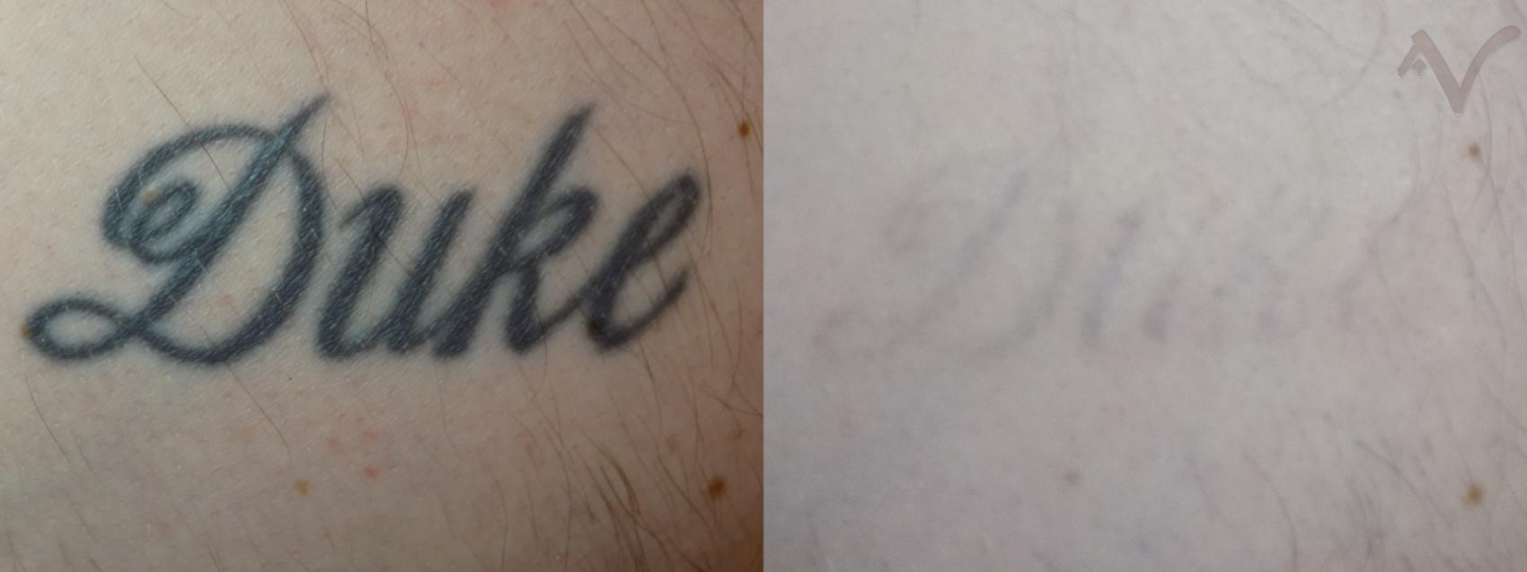 Before & After PicoSure Laser Tattoo Removal Case 33 Chest View in Los Angeles, CA