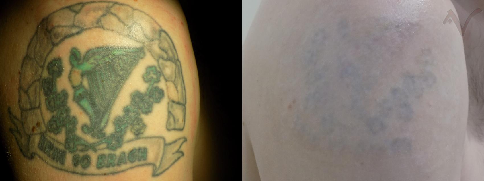 Before & After Laser Tattoo Removal Case 33 Right Shoulder View in Los Angeles, CA