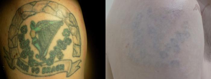 Before & After PicoSure Laser Tattoo Removal Case 33 Right Shoulder View in Los Angeles, CA