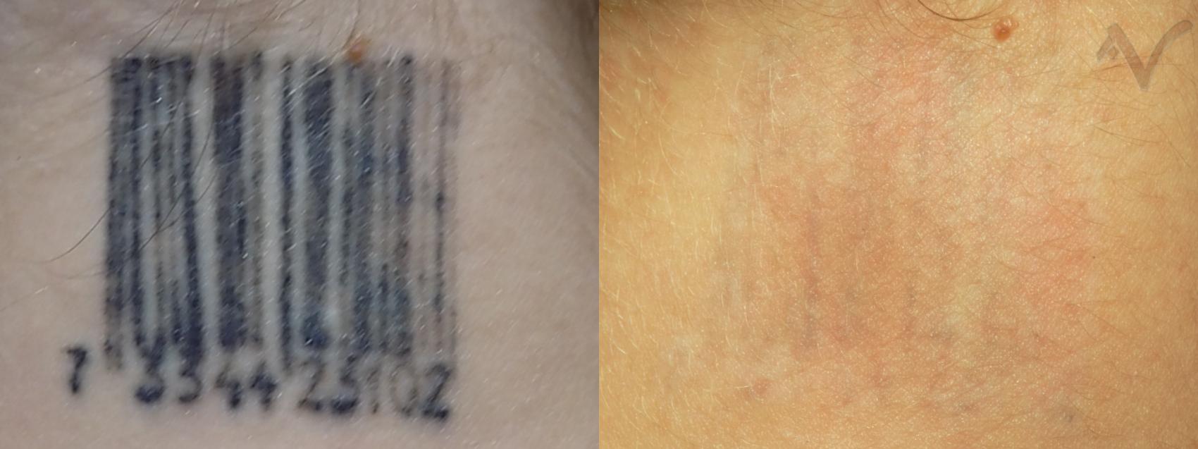 Before & After PicoSure Laser Tattoo Removal Case 34 Back of Neck View in Burbank, CA