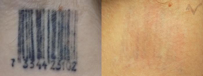 Before & After PicoSure Laser Tattoo Removal Case 34 Back of Neck View in Los Angeles, CA