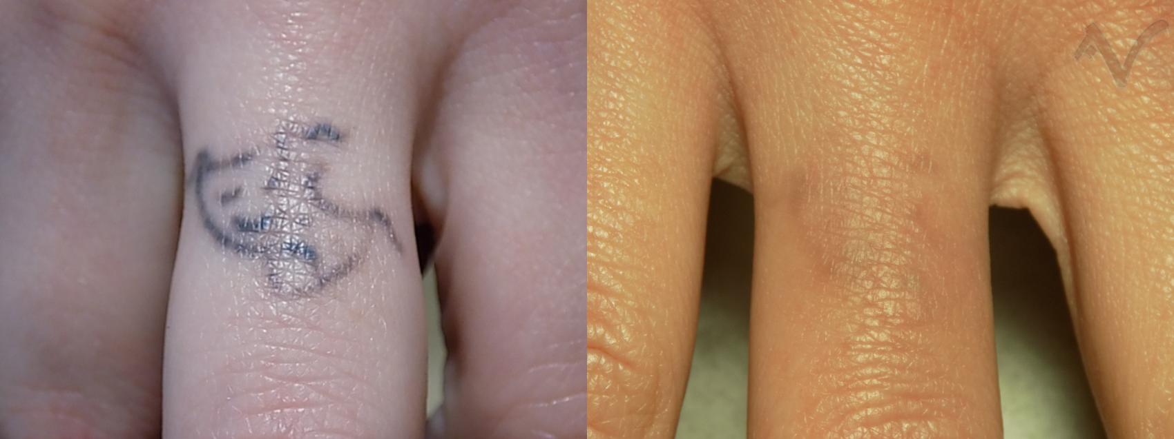 Before & After PicoSure Laser Tattoo Removal Case 34 Finger View in Burbank, CA