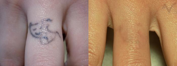 Before & After PicoSure Laser Tattoo Removal Case 34 Finger View in Los Angeles, CA