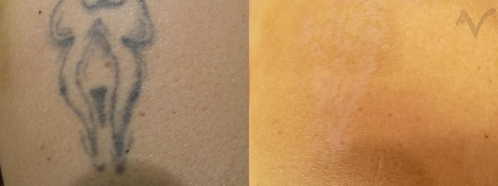 Before & After PicoSure Laser Tattoo Removal Case 35 Right Side View in Los Angeles, CA