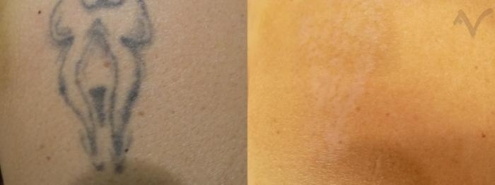 Before & After PicoSure Laser Tattoo Removal Case 35 Right Side View in Los Angeles, CA