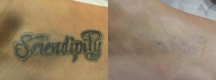 Before & After PicoSure Laser Tattoo Removal Case 36 Foot View in Los Angeles, CA