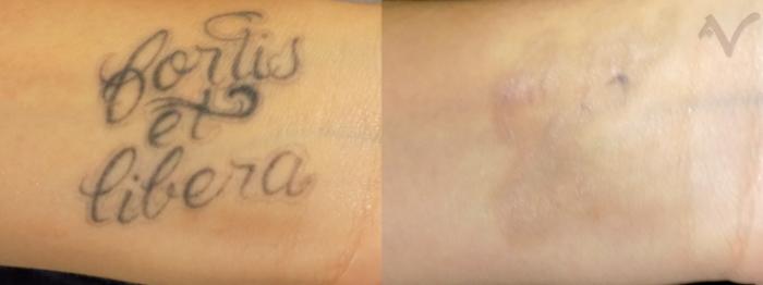 Before & After PicoSure Laser Tattoo Removal Case 36 Left Wrist View in Los Angeles, CA
