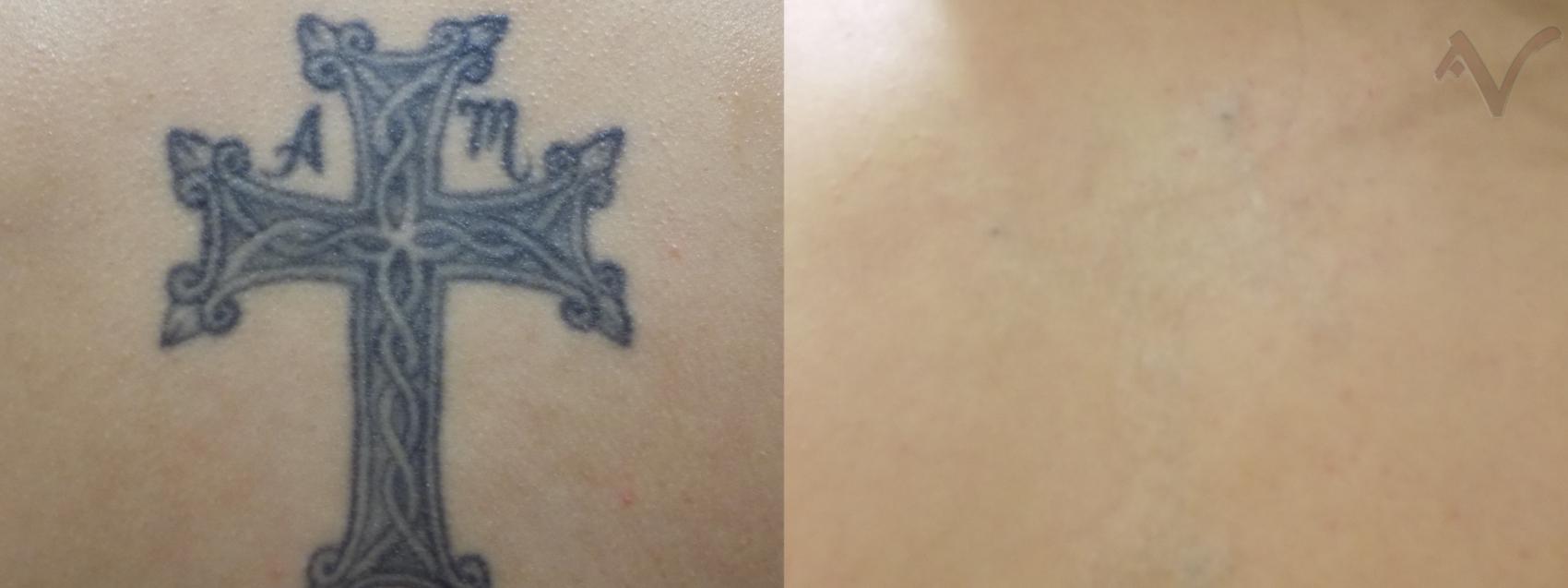 Before & After PicoSure Laser Tattoo Removal Case 367 Front View in Los Angeles, CA