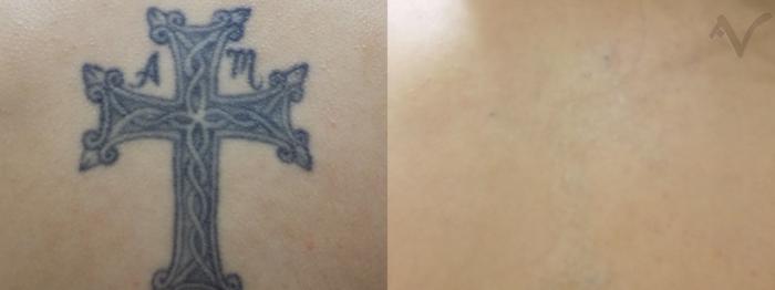 Before & After PicoSure Laser Tattoo Removal Case 367 Front View in Los Angeles, CA