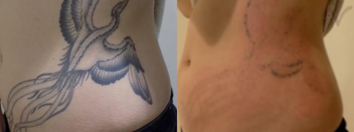 Before & After PicoSure Laser Tattoo Removal Case 37 Left Oblique View in Los Angeles, CA