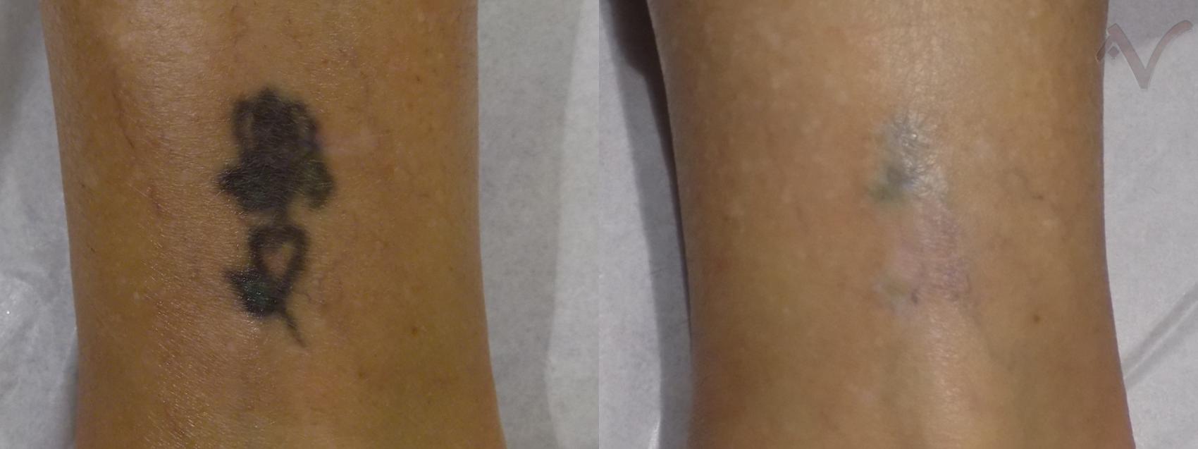 Before & After Laser Tattoo Removal Case 38 Ankle View in Los Angeles, CA