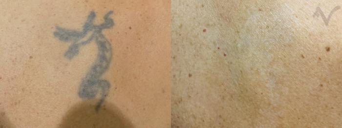 Before & After PicoSure Laser Tattoo Removal Case 38 Back View in Los Angeles, CA