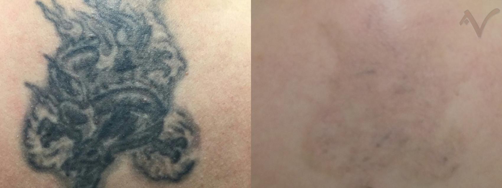 Before & After PicoSure Laser Tattoo Removal Case 39 Back View in Los Angeles, CA