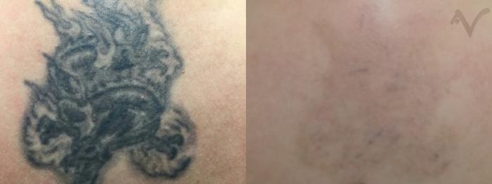 Before & After PicoSure Laser Tattoo Removal Case 39 Back View in Los Angeles, CA