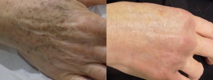 Before & After PicoSure Skin Rejuvenation Case 24 Back of right hand View in Los Angeles, CA