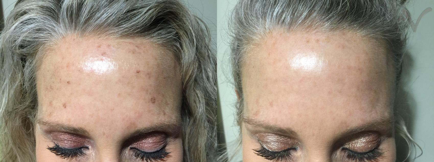 Before & After Laser Skin Rejuvenation Case 25 Front View in Los Angeles, CA