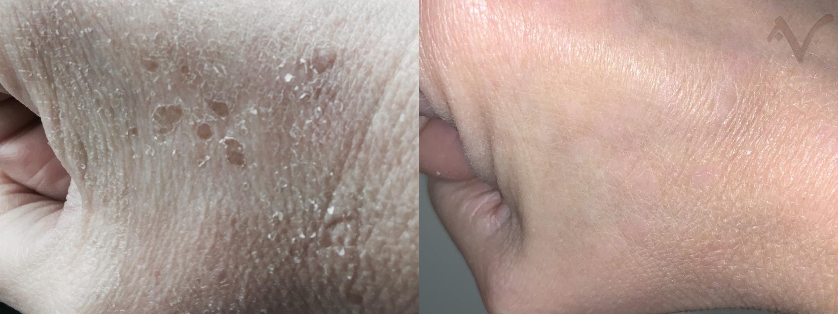 Before & After Laser Skin Rejuvenation Case 26 Back of right hand View in Los Angeles, CA