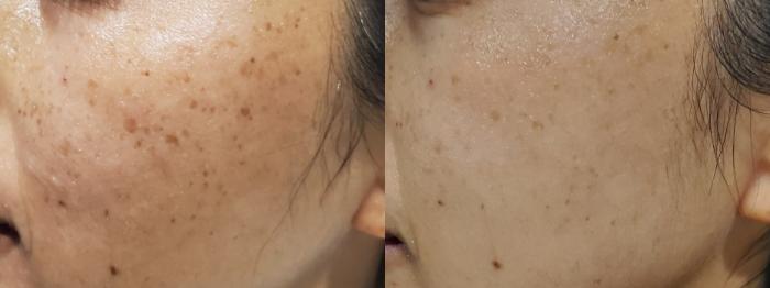 Before & After PicoSure Skin Rejuvenation Case 390 Left Side View in Los Angeles, CA