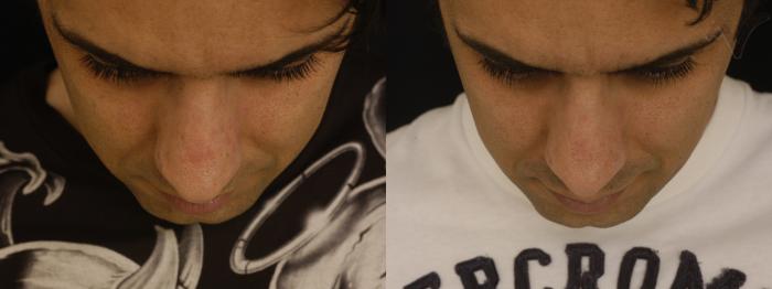 Before & After Revision Rhinoplasty Case 10 Downward Gaze View in Los Angeles, CA