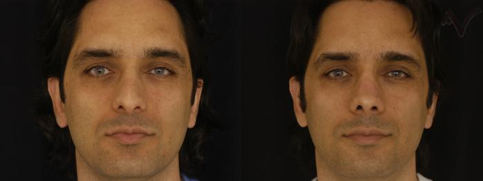 Before & After Revision Rhinoplasty Case 10 Front View in Los Angeles, CA