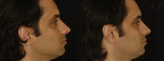 Before & After Revision Rhinoplasty Case 10 Right Side View in Los Angeles, CA