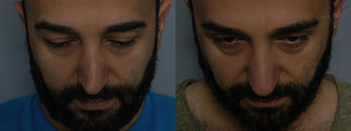 Before & After Revision Rhinoplasty Case 11 Downward Gaze View in Los Angeles, CA