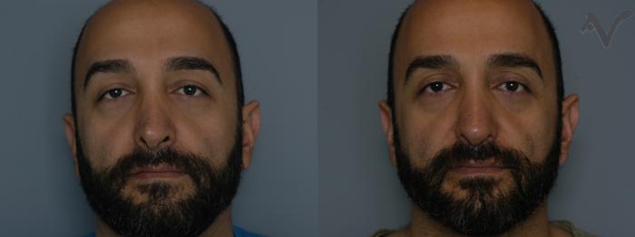 Before & After Revision Rhinoplasty Case 11 Front View in Los Angeles, CA
