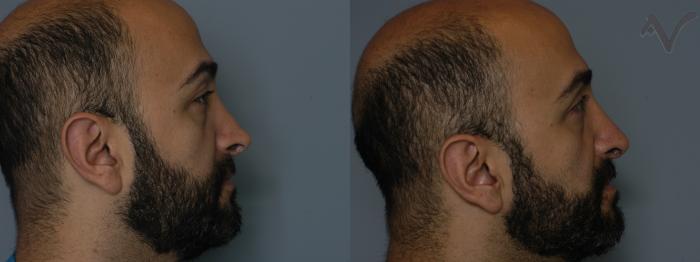 Before & After Revision Rhinoplasty Case 11 Right Side View in Los Angeles, CA