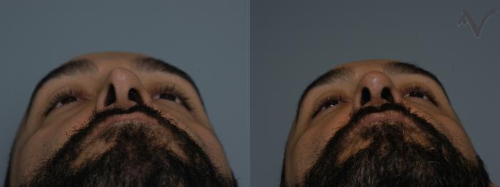 Before & After Revision Rhinoplasty Case 11 Upward Gaze View in Los Angeles, CA