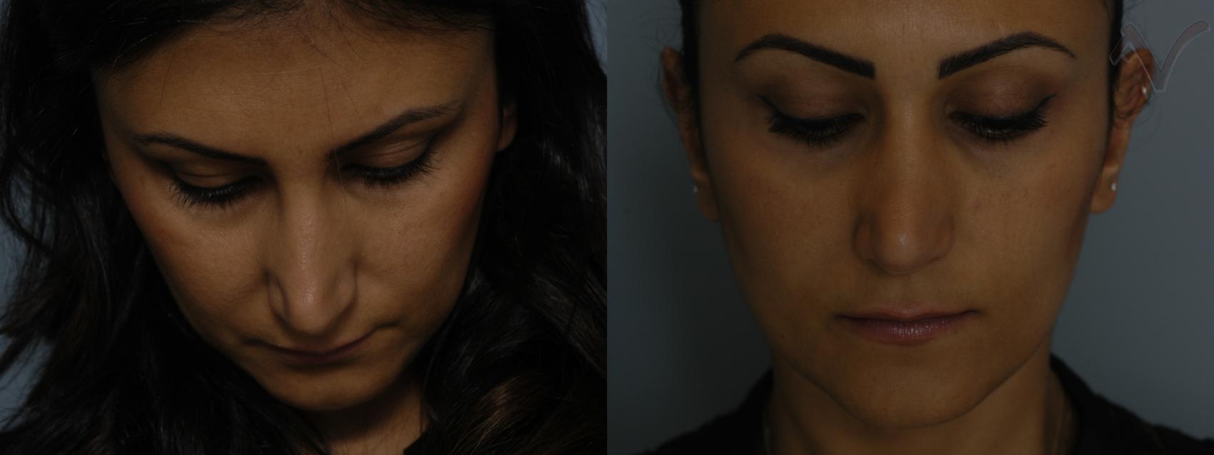 Before & After Revision Rhinoplasty Case 12 Downward Gaze View in Burbank, CA