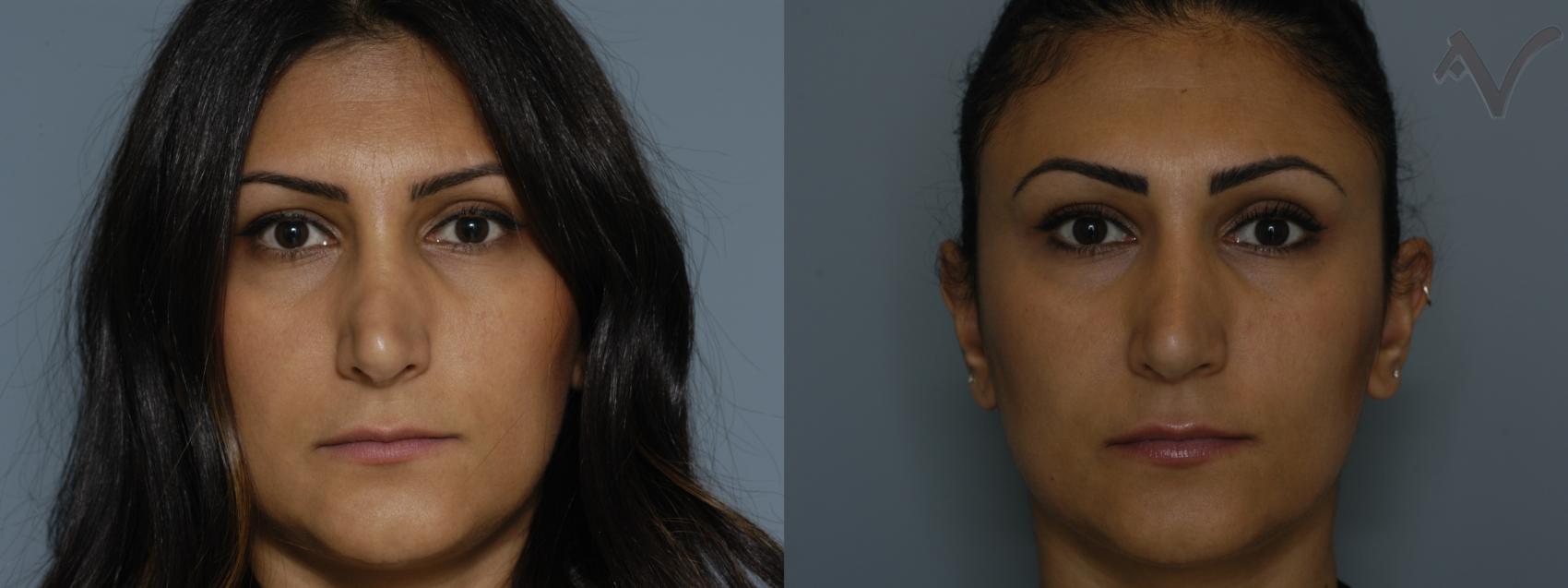 Before & After Revision Rhinoplasty Case 12 Front View in Burbank, CA