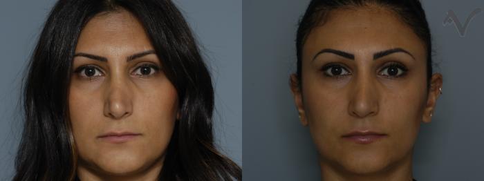Before & After Revision Rhinoplasty Case 12 Front View in Los Angeles, CA