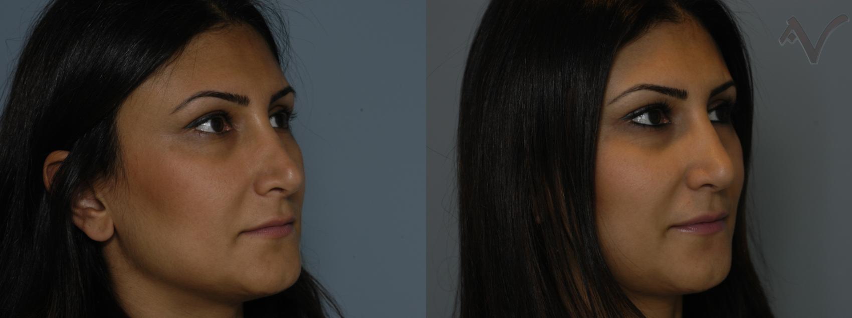 Before & After Revision Rhinoplasty Case 12 Left Oblique View in Burbank, CA