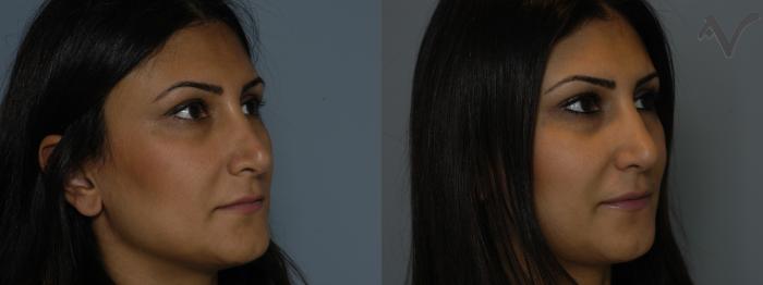 Before & After Revision Rhinoplasty Case 12 Left Oblique View in Los Angeles, CA