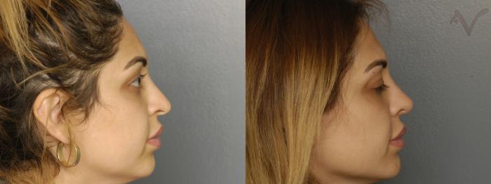 Before & After Revision Rhinoplasty Case 334 Right Side View in Los Angeles, CA