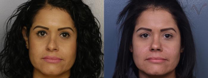 Before & After Revision Rhinoplasty Case 417 Front View in Los Angeles, CA
