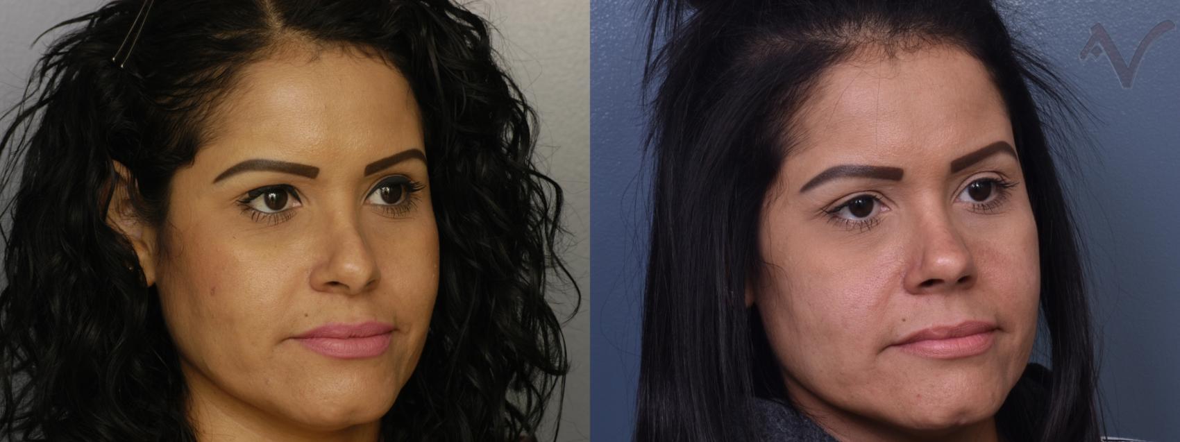 Before & After Revision Rhinoplasty Case 417 Right Oblique View in Los Angeles, CA