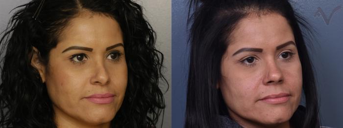 Before & After Revision Rhinoplasty Case 417 Right Oblique View in Los Angeles, CA