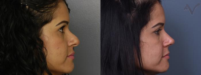 Before & After Revision Rhinoplasty Case 417 Right Side View in Los Angeles, CA