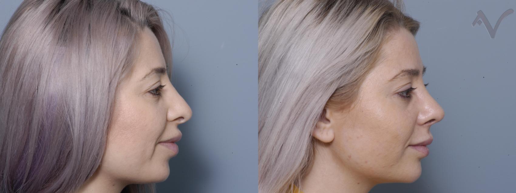 Before & After Revision Rhinoplasty Case 68 Right Side View in Burbank, CA