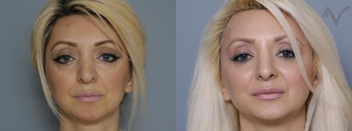 Before & After Revision Rhinoplasty Case 9 Front View in Los Angeles, CA