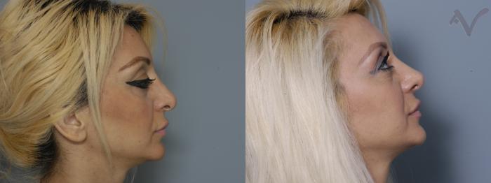 Before & After Revision Rhinoplasty Case 9 Right Side View in Los Angeles, CA