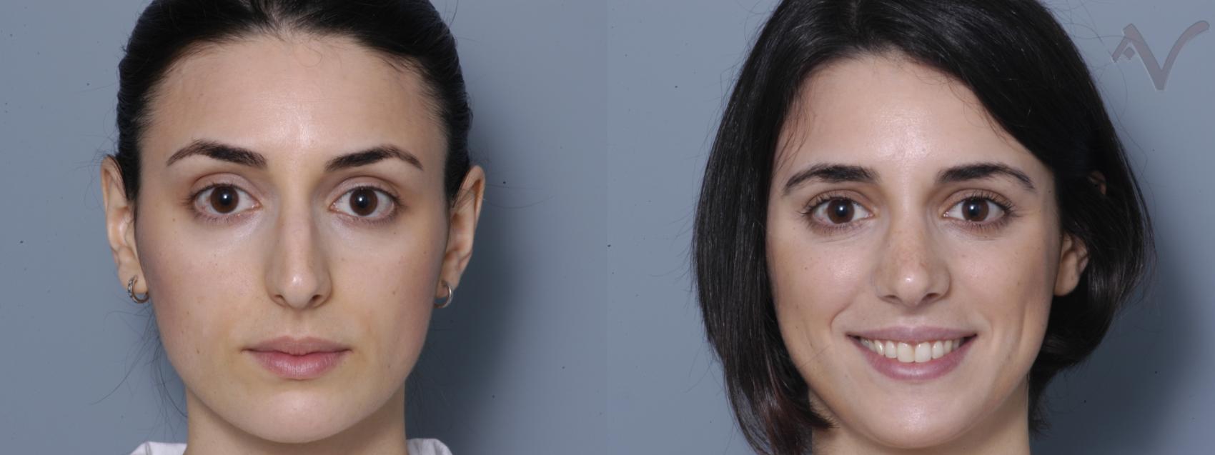 Before & After Rhinoplasty Case 1 Front View in Los Angeles, CA