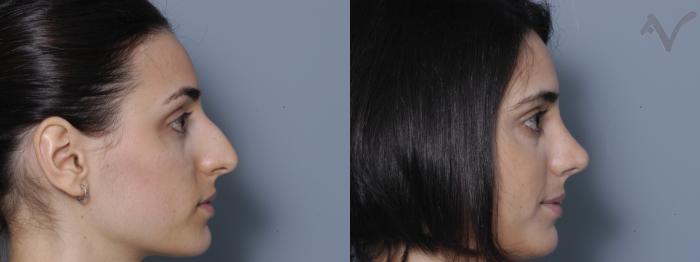 Before & After Rhinoplasty Case 1 Right Side View in Los Angeles, CA