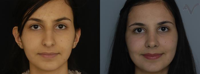 Before & After Rhinoplasty Case 188 Front View in Los Angeles, CA