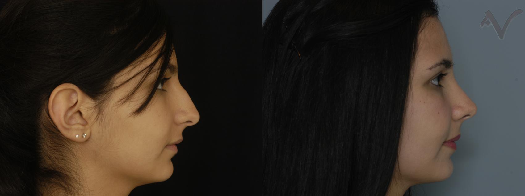 Before & After Rhinoplasty Case 188 Right Side View in Los Angeles, CA