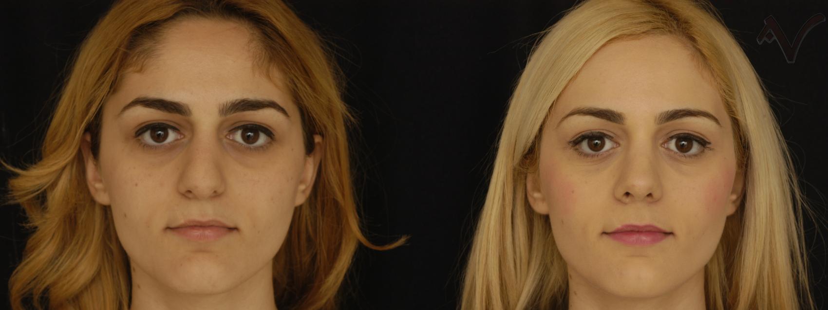 Before & After Rhinoplasty Case 189 Front View in Los Angeles, CA