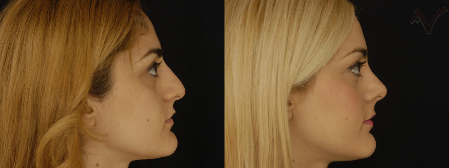 Before & After Rhinoplasty Case 189 Right Side View in Los Angeles, CA