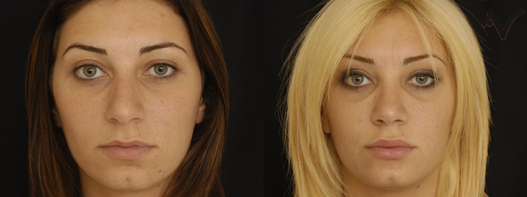Before & After Rhinoplasty Case 196 Front View in Los Angeles, CA