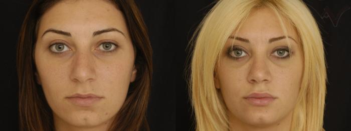 Before & After Rhinoplasty Case 196 Front View in Los Angeles, CA